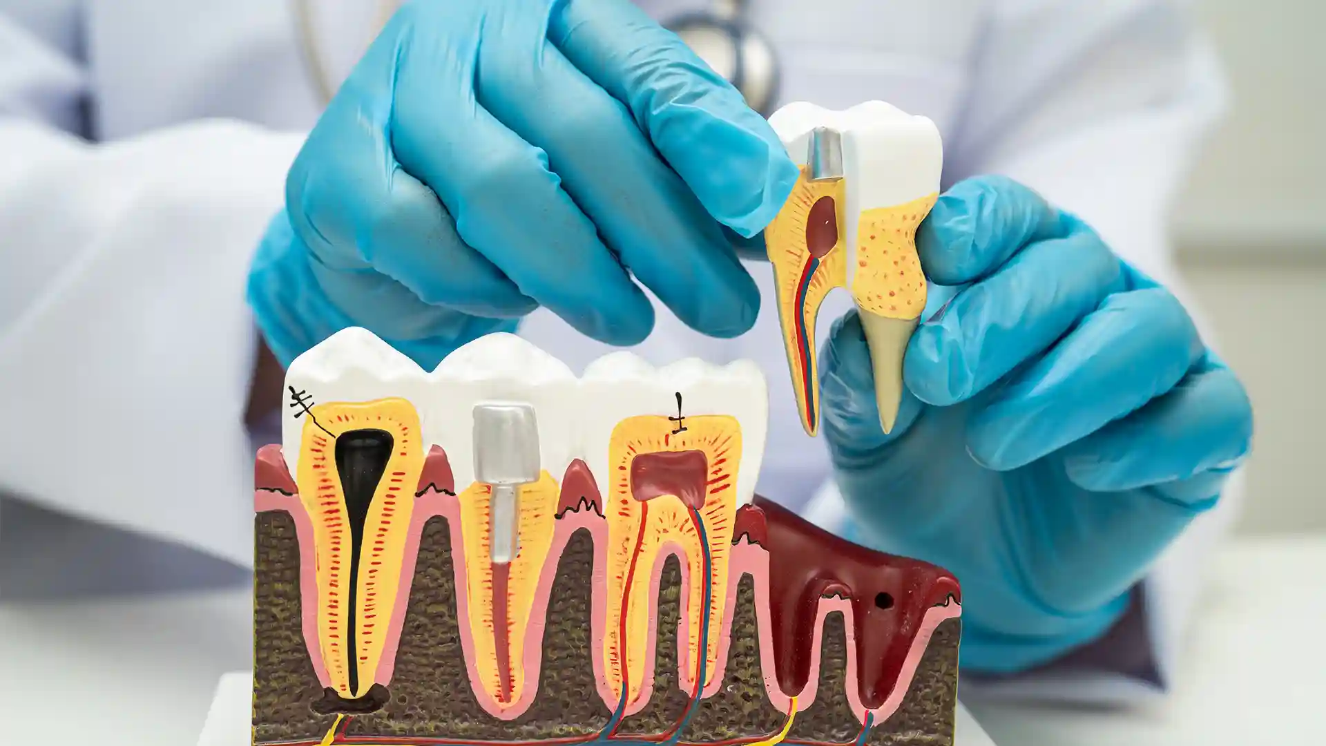 Dead nerve in tooth no pain